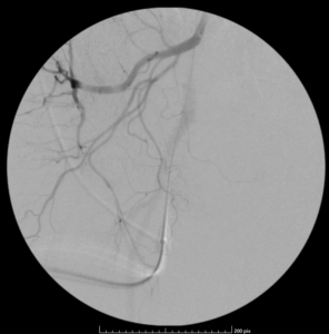 Right pelvis angiogram image from a prostate artery embolization procedure