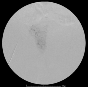 Right prostatic artery angiogram image from a prostate artery embolization procedure